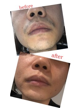 リエール(Le:YELL)/ヒゲ脱毛ビフォーアフター