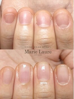 マリーロール 梅田店(Marie Laure)/自爪育成/深爪矯正/ネイルケア