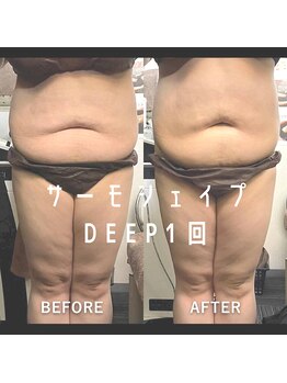 リラクゼーションサロン ラキ(laki)/サーモシェイプDEEP/痩身