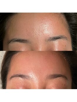 ウイユ(Oeil)/剥けるハーブピーリング 効果1回