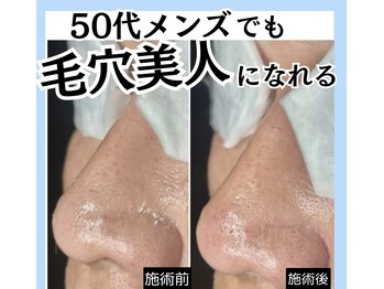 脱毛マックス 南越谷店(MAX)/メンズ/フェイシャルエステ