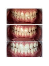 ホワイトニング ビューティー 南魚沼店(whitening beauty)/歯医者並みの白さへ
