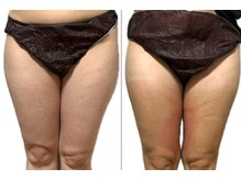 サロンドモフィ(salon de moffy)/痩身【脂肪冷却】内もも施術例８