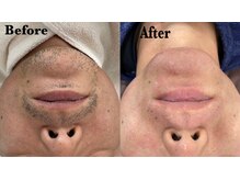 ディアー 原宿(Diar)/ヒゲ脱毛　メンズ