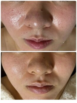 マリエンドリー/ざらつき/赤ら顔/毛穴