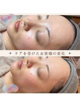 美肌研究所 絹 田辺店/FaceWax*うぶ毛スッキリ★艶肌に