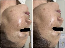 ルビー(Ruby)/【50代】しみ・くすみ悩み・3回