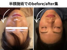 メハル(meharu)の雰囲気（頬骨の高さ、ほうれい線に注目半顔写真ご希望でお撮りします）