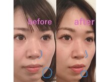 ラプリボヤージュ 藤沢店(Raplit)の雰囲気（鼻は一度高くなるとほぼ戻らない!#隆鼻矯正#小顔#藤沢＃ラプリ）