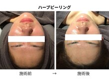 エルヴェ(Eleve)/くすみ知らずの透明感へ