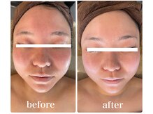 オレアグリーン 岡崎(OLEA green)/before after(小顔/筋膜/毛穴)
