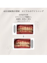 プラスビーセルフ(+b self)/ホワイトニングビフォーアフター