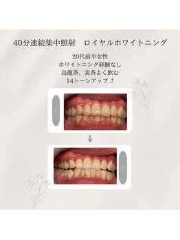 プラスビーセルフ(+b self)/ホワイトニングビフォーアフター