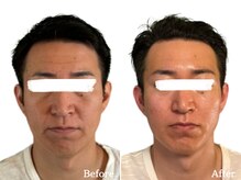 グロウズ(Glows)/おでこのシワやほうれい線の改善