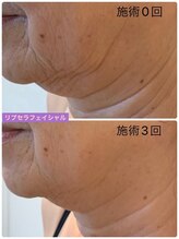 プリュネル(Prunelle)/プラズマシャワー