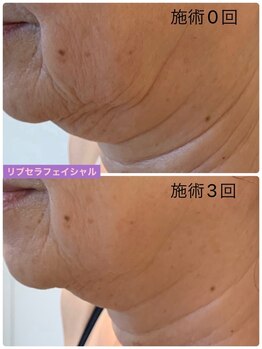 プリュネル(Prunelle)/プラズマシャワー