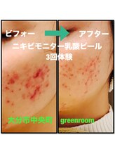 グリーンルーム(green room)/ニキビケアモニター3回目