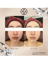 ココ センガ ビューティー クリニック(COCO SENGA Beauty-Clinic)/韓国肌管理プラピール効果写真