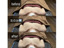 リノレア(LinoLea)/バストアップBefore after