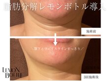 ヌナ(NOONA)/レモンボトルお客様[小顔]