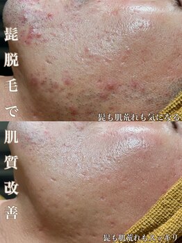 サロン ド マキ(Salon de Maki)/肌荒れのお悩み?脱毛やってみて