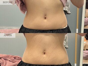 レヴェリー 心斎橋店(REVERIE)/‐ BODYお肉取り ‐