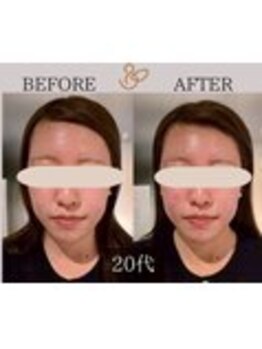 チョコバリ 錦糸町店(chocobari)/小顔×リフトアップ(美容鍼)20代