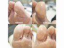 足裏角質除去