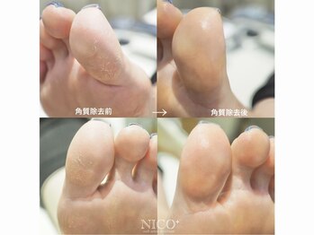 ニコプラス 大橋店(NICO+)/足裏角質除去