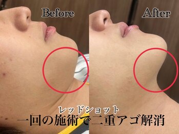 アンドエス 六本木(and S.)/韓国発!最新美容レッドショット