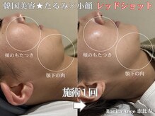 ボニータアンジュ 恵比寿(Bonita Ange)の雰囲気(レモンボトルを超えたと噂のレッドショットで脂肪分解×小顔ケア)