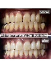 ホワイト 天王寺店(White)/Whitening症例before→after