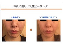 ベッラドンナ(Bella donna)/肌荒れ　BeforeAfter