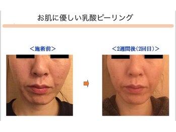 ベッラドンナ(Bella donna)/肌荒れ BeforeAfter