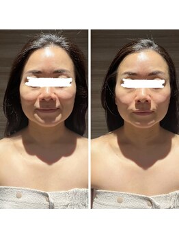 ギンザクリア 銀座本店(GINZA CLEAR)/リフトアップ超音波＋小顔コルギ