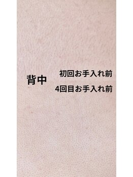 アンジェム(Angem)/背中のビフォーアフター