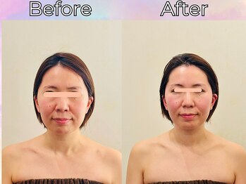 リストアハート(Restore Heart)/たるみの改善♪