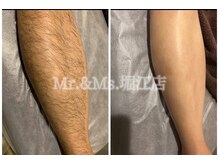 ミスターアンドミス 四ツ橋 堀江店(Mr.&Ms.)の雰囲気（人気No.1メンズ全身脱毛beforeafter(5回)/髭/VIO/ご紹介ペアも◎）