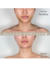 術後の女神 大阪心斎橋店/術後ケアインディバ・インディバ