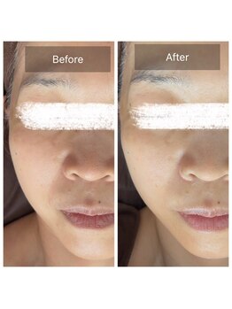 ラビ(RABBI)/50代女性小顔矯正