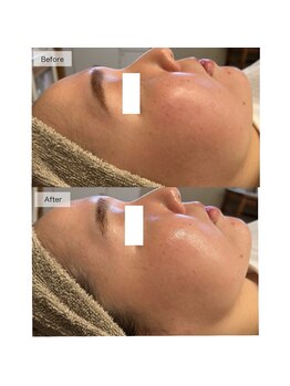 フイユ(feuille)/UNSTRESS 乳酸菌ピーリング