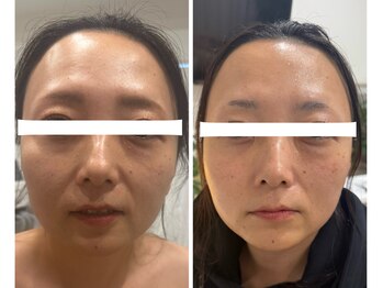 ありひ/オーダーメイドエステの効果！！