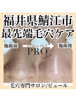 ピュール 鯖江店(PUR)/毛穴/毛穴ケア/毛穴洗浄