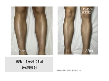 ベルフィオーレ(bel fiore)の写真/夏に差がつく！【リピート多数★当店人気No.1メニュー足脱毛】メンズ脱毛で清潔感あふれる爽やか素肌へ♪
