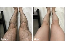 セラス(CERAS)/男性の足脱毛