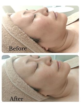 セレニテ(Serenite)/ラジオ波デコルテ