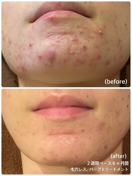 ツヤハダコガオ 千葉店/before⇒afterハーブピーリング