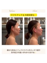 アイシー(I Sea)/小顔効果もバッチリ☆