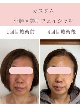 シンナリ(Shinnari)/カスタム小顔×美肌フェイシャル