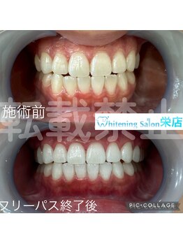 ホワイトニングサロン 名古屋 栄店/【ホワイトニング】